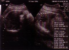 ９ヶ月の胎児
