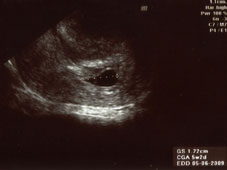妊娠６週エコー画像