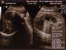 妊娠３７週エコー画像