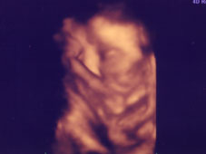 妊娠３７週４Ｄエコー画像