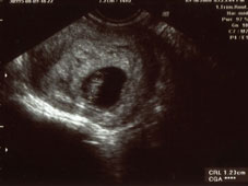 妊娠７週エコー画像