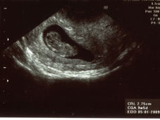 妊娠９週エコー画像