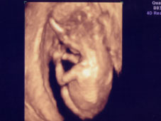 妊娠１１週４Ｄエコー画像
