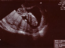 妊娠１１週エコー画像