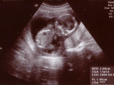 妊娠１６週エコー画像