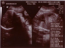 妊娠３１週エコー画像