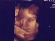 妊娠３１週４Ｄエコー画像