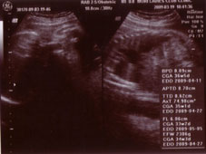 妊娠３３週エコー画像