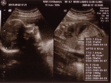 妊娠２９週エコー画像